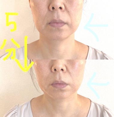 ReFa BEAUTECH RAISEのビフォーアフター