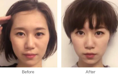 コアフィットのポスポス美顔器を使用したビフォーアフター体験談②