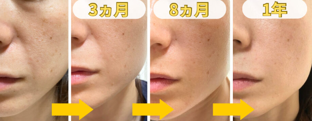 ディマーニ美顔器を使用したビフォーアフター体験談②